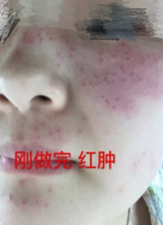 做了激光祛斑术后果反馈和经验分享
