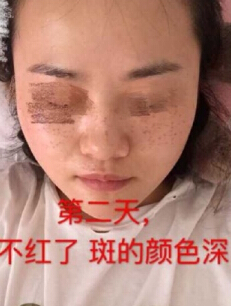 做了激光祛斑术后果反馈和经验分享