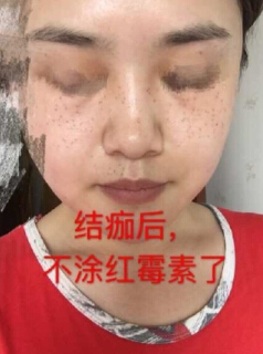 做了激光祛斑术后果反馈和经验分享