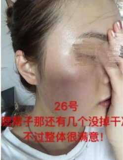 做了激光祛斑术后果反馈和经验分享