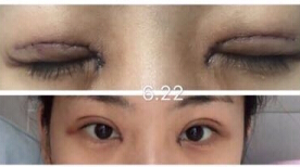 北京八大处尹琳医生做的手术怎么样?