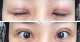 北京八大处尹琳医生做的手术怎么样?