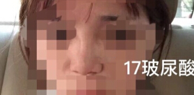 宁波壹加壹整形美容医院做的隆鼻手术