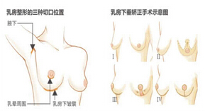 乳房悬提术：胸部下垂不是问题