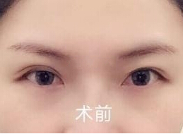 南京康美整形美容医院陈小剑医生手术案例