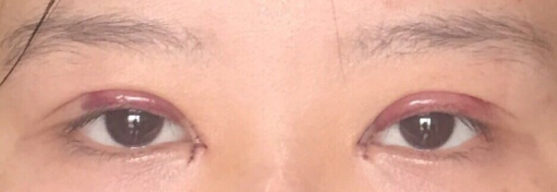 北京八大处甘承医生做的双眼皮开眼角手术