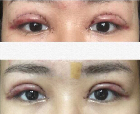 做双眼皮真的就是要心态好