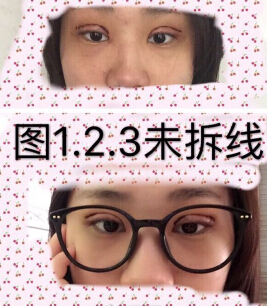 深圳市眼科医院叶琳医生手术果怎么样？