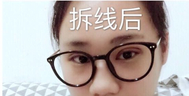 深圳市眼科医院叶琳医生手术果怎么样？