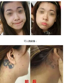 乳晕漂红用激光美肤?