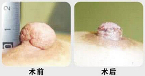 乳头乳晕缩小,乳头内陷矫正术