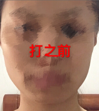 注射注射瘦脸术后果反馈