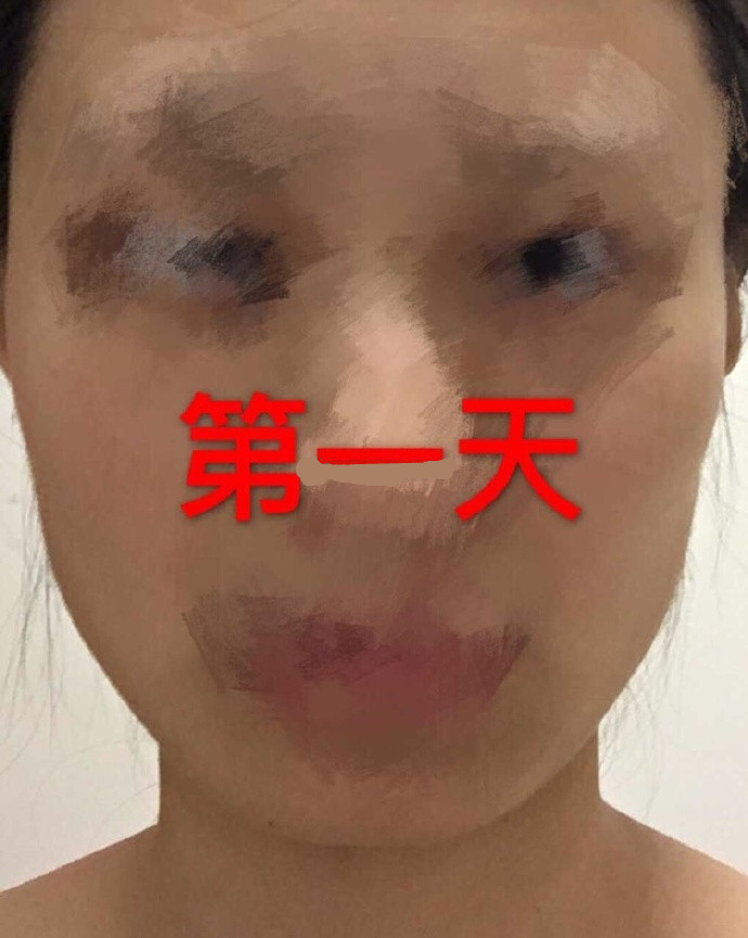 注射注射瘦脸术后果反馈