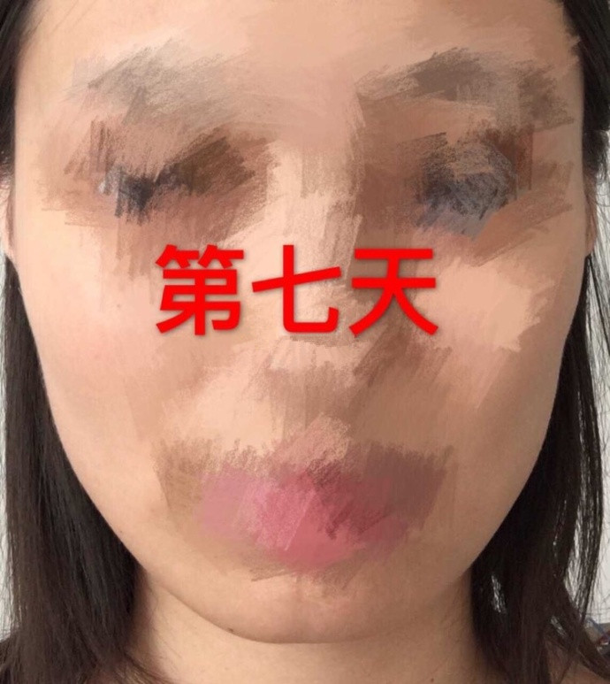 注射注射瘦脸术后果反馈