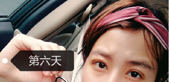 浙江省第一医院整形美容中心叶秀娣医生手术案