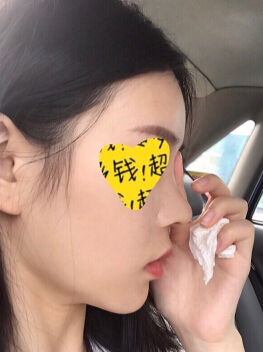 上海百达丽整形美容医院顾清医生手术案例