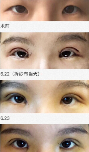做完双眼皮手术啦,来和大家分享一下