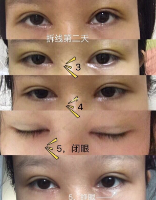 广西南宁华美整形医院***医生手术案例