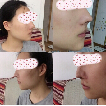 今年做的疤痕修复,等恢复好了就去做激光