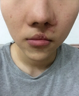 今年做的疤痕修复,等恢复好了就去做激光
