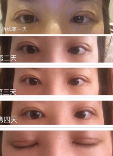 温州医科大学附属眼视光医院陈熙医生手术案例
