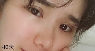 长沙市美之峰医疗美容整形医院丁翔医生手术案