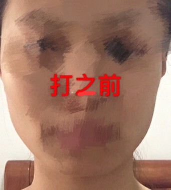 打注射瘦脸第七天了