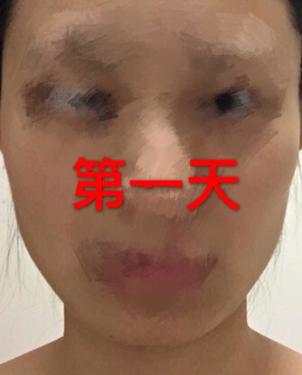 打注射瘦脸第七天了