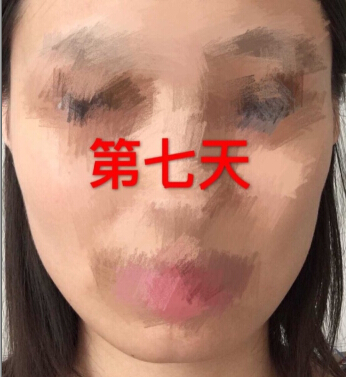打注射瘦脸第七天了