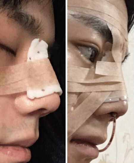 上海伊莱美李湘原院长做的鼻部手术