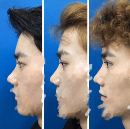 上海伊莱美李湘原院长做的鼻部手术