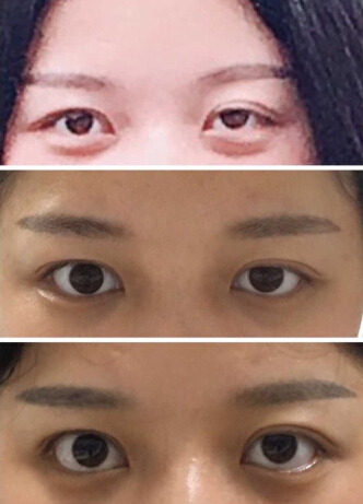 现在自然睁眼状态的眼睛有必要修复吗?