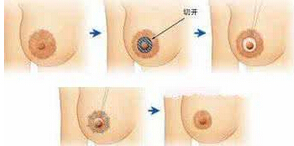 乳晕大是怎么回事?色彩加深怎么办
