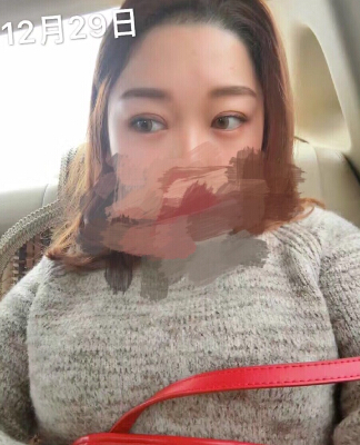 上海九院刘南琳医生做的全切双眼皮手术