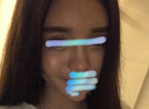 做完鼻部手术后你是否有鼻头变硬变大现象?