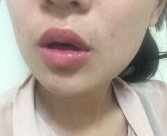 北京伊美尔整形美容医院注射瘦脸和玻尿酸填充