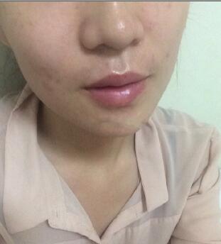 北京伊美尔整形美容医院注射瘦脸和玻尿酸填充