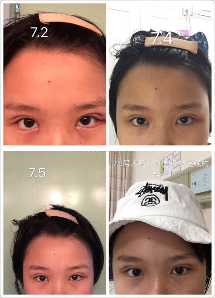 省中医院王金明医生做的双眼皮开眼角手术