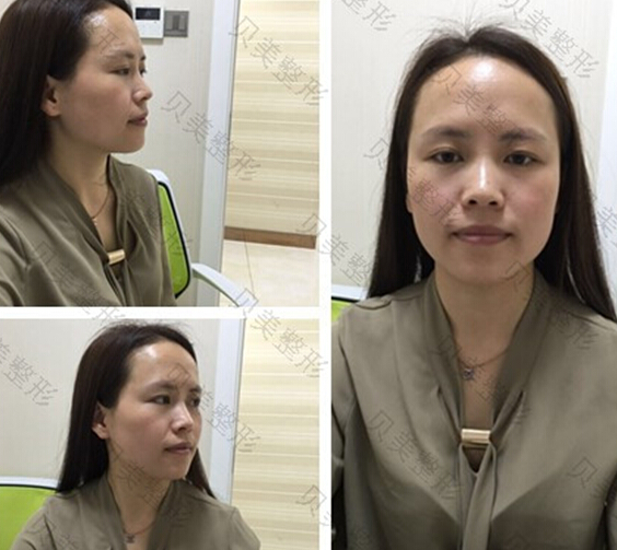 长沙贝美整形熊宜文院长做的假体隆鼻部手术