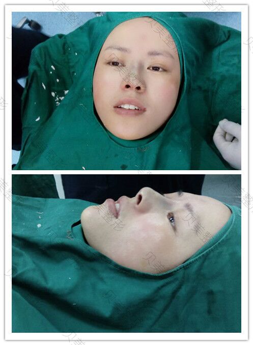 长沙贝美整形熊宜文院长做的假体隆鼻部手术