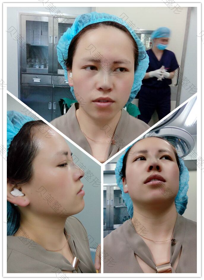 长沙贝美整形熊宜文院长做的假体隆鼻部手术