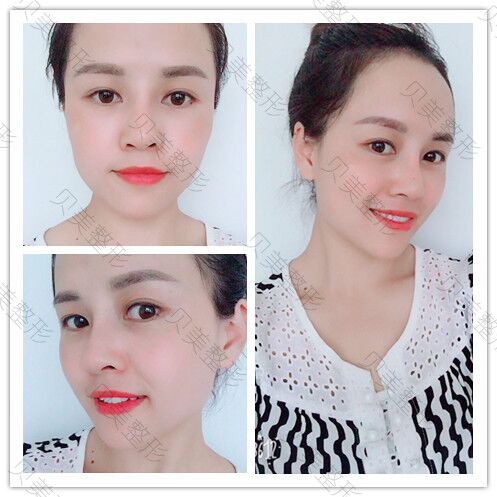 长沙贝美整形熊宜文院长做的假体隆鼻部手术