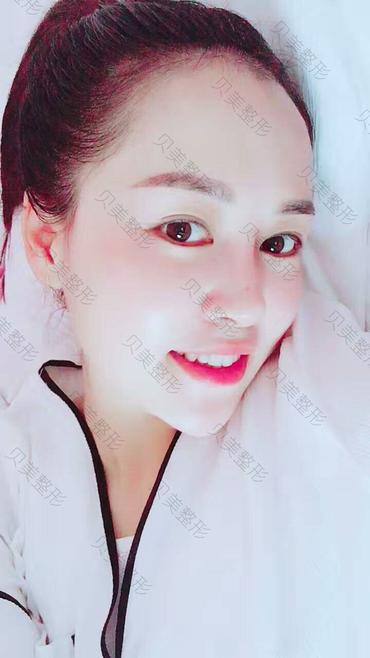 长沙贝美整形熊宜文院长做的假体隆鼻部手术