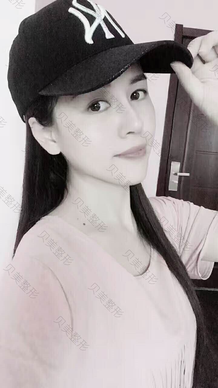 长沙贝美整形熊宜文院长做的假体隆鼻部手术