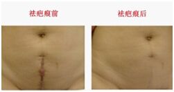 武汉新至美整形医院周彬手术案例
