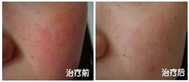 武汉新至美整形医院周彬手术案例