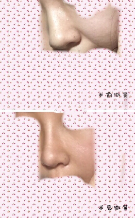 浙江省人民医院整形外科孙燚医生做的鼻部手术