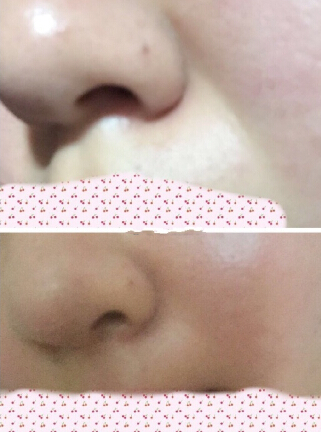 浙江省人民医院整形外科孙燚医生做的鼻部手术