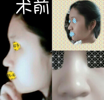 成都铜雀台整形美容医院陈远琨做的鼻部手术