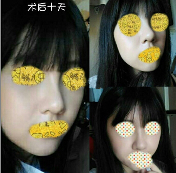 成都铜雀台整形美容医院陈远琨做的鼻部手术
